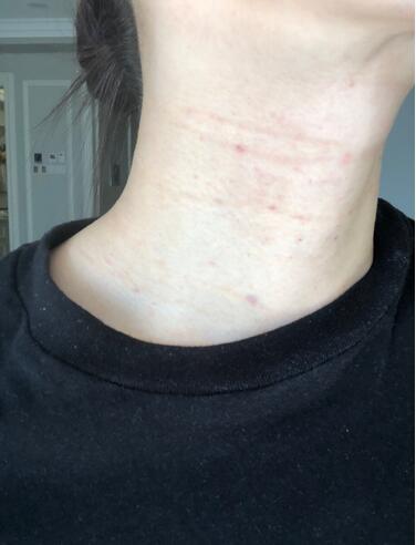 做完液態(tài)超聲刀注意什么。