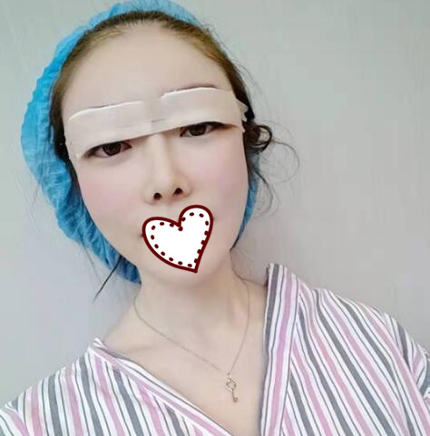 剛做完雙眼皮手術，還在恢復過程中