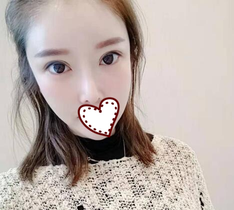 雙眼皮完全恢復之后的效果