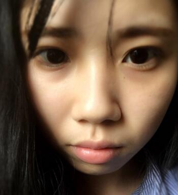 做完鼻骨縮窄手術(shù)七天后的樣子 做完鼻骨縮窄手術(shù)七天后的樣子