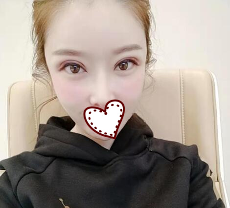 做完雙眼皮之后的效果