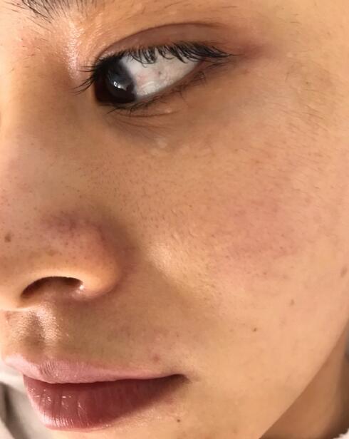 做光子嫩膚手術(shù)之前 做光子嫩膚手術(shù)之前