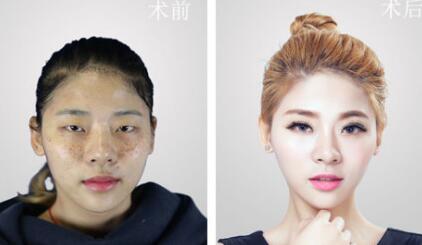 福州愛思特比華利整形林秋榮激光祛斑案例效果對(duì)比圖