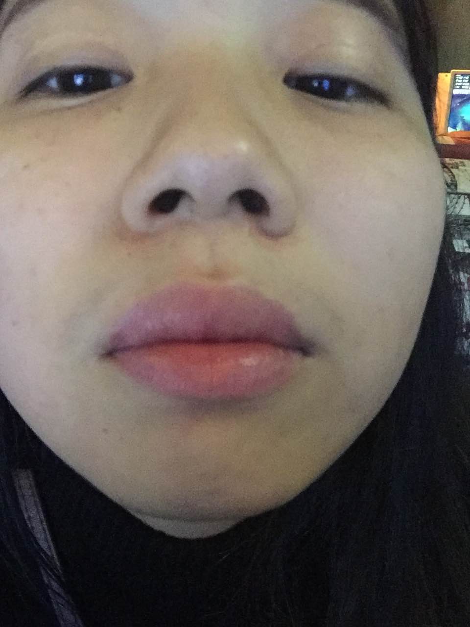 滄州瑞美醫(yī)療美容門診部整形醫(yī)生王波鼻骨縮窄案例 滄州瑞美醫(yī)療美容門診部整形醫(yī)生王波鼻骨縮窄案例