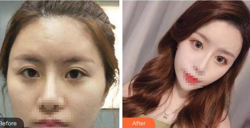 鄭州風(fēng)信子整形美容醫(yī)院雙眼皮案例效果對比圖分享