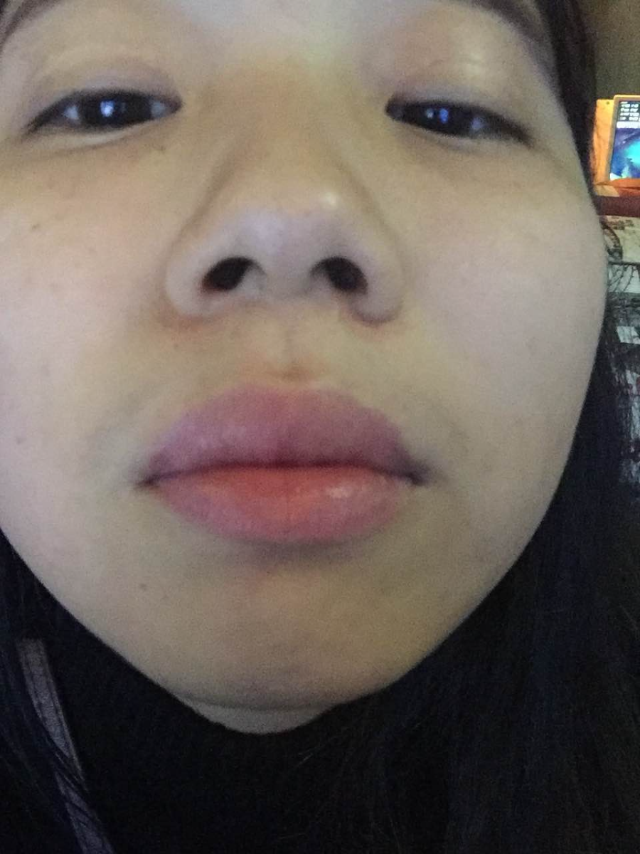 滄州瑞美醫(yī)療美容門(mén)診部王波醫(yī)生鼻骨縮窄案例，拯救了我的丑鼻子