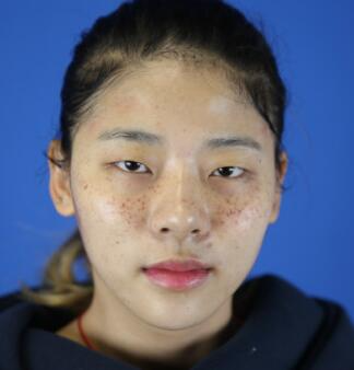 福州愛思特比華利整形林秋榮激光祛斑效果太贊了，終于沒人叫我“斑花”了