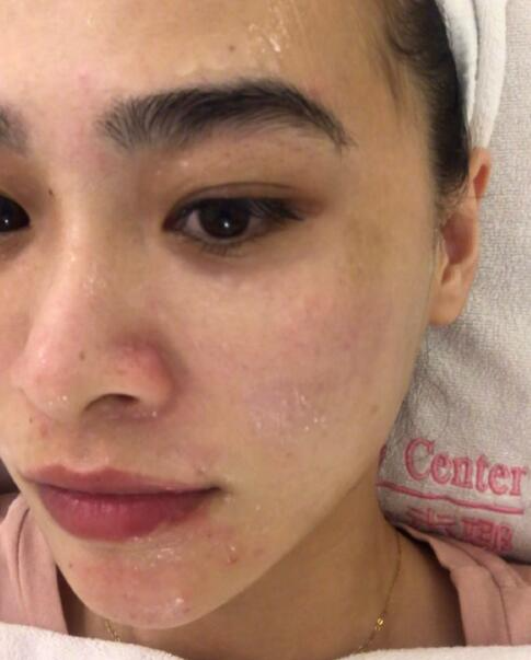 福州愛思特比華利整形林秋蓉醫(yī)生做光子嫩膚過程體驗！皮膚Q彈