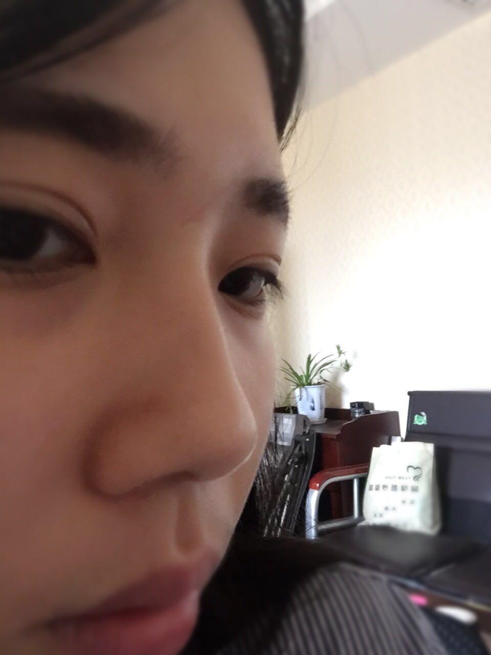 做完鼻骨縮窄手術(shù)一個多月的樣子 做完鼻骨縮窄手術(shù)一個多月的樣子