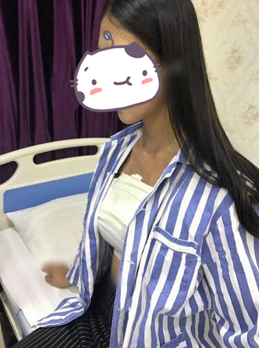 北京冰蝶醫(yī)療整形張克旭琴面假體隆胸案例，隆胸效果對比圖