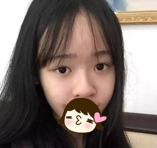 廈門海峽整形美容醫(yī)院醫(yī)生張宏隆鼻案例，效果很棒