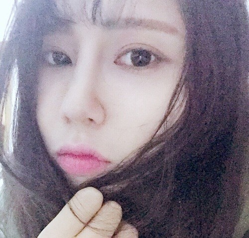 滄州瑞美醫(yī)療美容門(mén)診部王波醫(yī)生鼻骨縮窄案例，拯救了我的丑鼻子