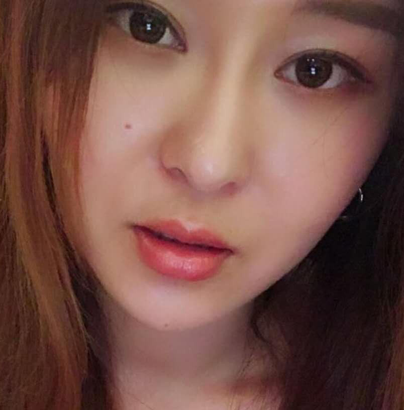 玻尿酸豐唇手術(shù)術(shù)后效果