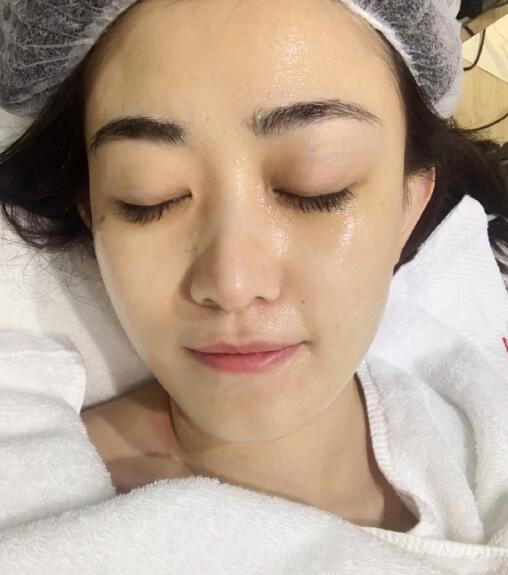 果酸換膚前 果酸換膚前