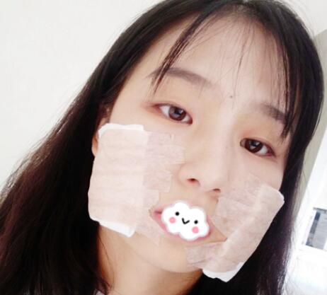 下頜角案例手術(shù)