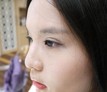 青島大學(xué)醫(yī)學(xué)院整形美容科陳振宇醫(yī)生做雙眼皮怎么樣？案例效果太驚艷