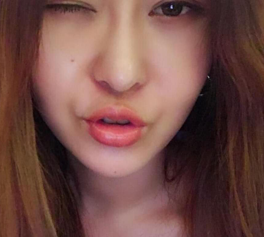 開始玻尿酸豐唇手術(shù)