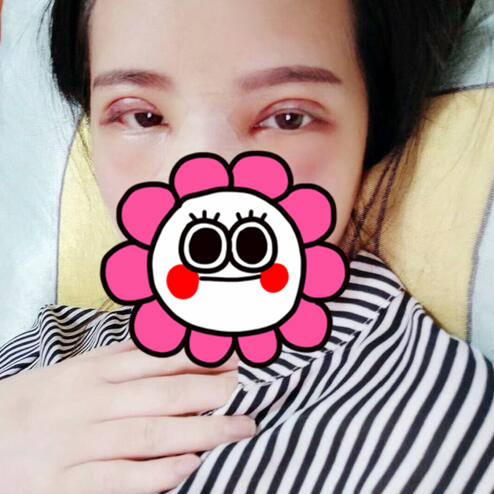 剛做完切開(kāi)雙眼皮時(shí)的樣子