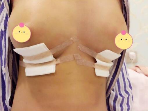 琴面假體隆胸手術(shù)剛結(jié)束的時候