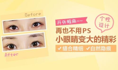 北京美萊整形專家杜園園開外眼角怎么樣?