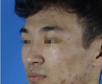 謝娟醫(yī)生做彩光嫩膚案例 謝娟醫(yī)生做彩光嫩膚案例