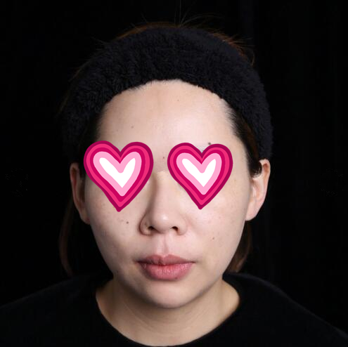 西安儷人醫(yī)院整形醫(yī)生蘇鵬做隆鼻技術(shù)怎么樣？附蘇鵬醫(yī)生隆鼻案例