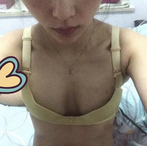 廣州駐顏光醫(yī)療美容診所整形專家劉培做復(fù)合隆胸技術(shù)怎么樣?附案例 廣州駐顏光醫(yī)療美容診所整形專家劉培做復(fù)合隆胸技術(shù)怎么樣?附案例