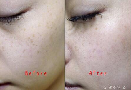 北京悅秀醫(yī)療整形專家楊勇山做激光去黃褐斑效果怎么樣?真實案例展示 北京悅秀醫(yī)療整形專家楊勇山做激光去黃褐斑效果怎么樣?真實案例展示