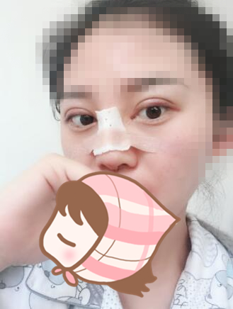 術后60天效果。