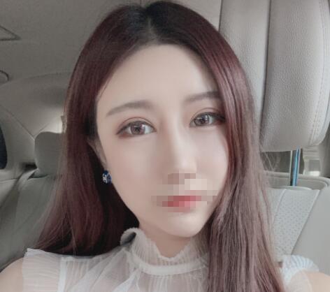 北京彤美整形醫(yī)院專家李長(zhǎng)賦做鼻部綜合整形怎么樣?李長(zhǎng)賦鼻綜合案例反饋 北京彤美整形醫(yī)院專家李長(zhǎng)賦做鼻部綜合整形怎么樣?李長(zhǎng)賦鼻綜合案例反饋