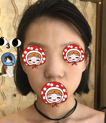 北京京韓醫(yī)療美容診所做硅膠隆鼻效果怎么樣？北京京韓醫(yī)療硅膠隆鼻案例