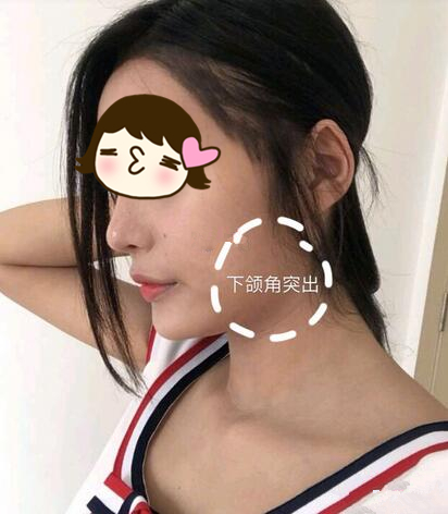 滄州瑞美醫(yī)療整形專家張鵬做下頜角磨骨整形技術(shù)怎么樣？附案例