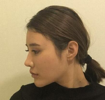 上海首爾麗格整形醫(yī)生樸興植做下頜角整形怎么樣？