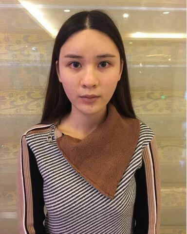 北京藝星整形專家郭峰做假體隆鼻修復(fù)怎么樣？郭峰假體隆鼻修復(fù)案例