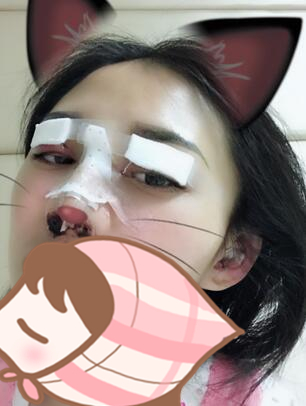 北京延世醫(yī)療整形專家周宜國做開外眼角技術怎么樣?周宜國開外眼角案例分享