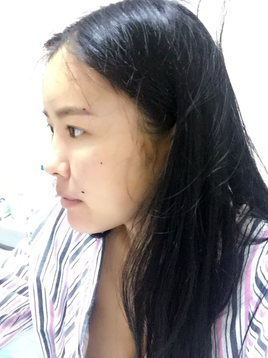 西安莎曼妃醫(yī)療美容醫(yī)院醫(yī)生樸俊做自體脂肪豐太陽穴效果怎么樣？