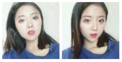 深圳嶺南醫(yī)院整形醫(yī)生丁祖鑫做假體豐太陽穴案例效果對(duì)比圖 深圳嶺南醫(yī)院整形醫(yī)生丁祖鑫做假體豐太陽穴案例效果對(duì)比圖