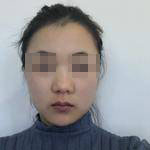 上海瑞麗整形醫(yī)生金炳建做肋軟骨隆鼻技術(shù)怎么樣？金炳建做肋軟骨隆鼻案例