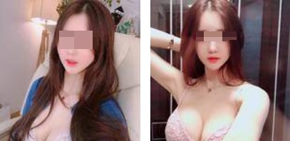 沈陽杏林整形美容醫(yī)院崔昌墉醫(yī)生做假體隆胸技術怎么樣？附案例