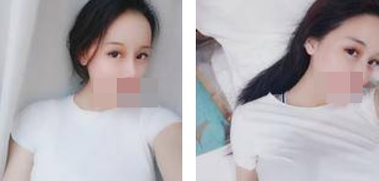 寧波美仁整形美容醫(yī)院李英大醫(yī)生做切開雙眼皮效果怎么樣？