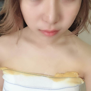 孫軼峰做假體隆胸案例效果對(duì)比圖 孫軼峰做假體隆胸案例效果對(duì)比圖