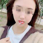 石家莊美然醫(yī)療整形醫(yī)生劉超做激光祛疤效果怎么樣？附劉超醫(yī)生案例