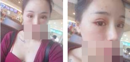 寧波美仁整形美容醫(yī)院李英大醫(yī)生做切開雙眼皮效果怎么樣？