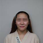 深圳尚虹醫(yī)療整形醫(yī)生藍(lán)劍雄做自體脂肪豐面頰效果怎么樣？附案例