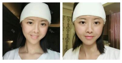 深圳嶺南醫(yī)院整形醫(yī)生丁祖鑫做假體豐太陽穴案例效果對(duì)比圖 深圳嶺南醫(yī)院整形醫(yī)生丁祖鑫做假體豐太陽穴案例效果對(duì)比圖