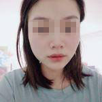 濟(jì)南曹博士美容整形醫(yī)院做玻尿酸豐面頰怎么樣？陳正喜醫(yī)生案例