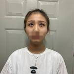 濟南鵬愛整形醫(yī)生楊力做顴骨顴弓整形技術(shù)怎么樣？楊力醫(yī)生案例展示