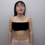 南寧伊美整形醫(yī)生凌宏量做自體脂肪隆胸怎么樣？自體脂肪隆胸案例