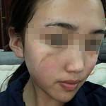 石家莊美然醫(yī)療整形醫(yī)生劉超做激光祛疤效果怎么樣？附劉超醫(yī)生案例