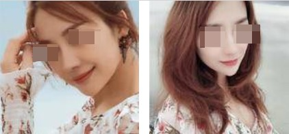 上海攸維醫(yī)療美容診所整形醫(yī)生李靜做膨體隆鼻效果怎么樣？附案例展示